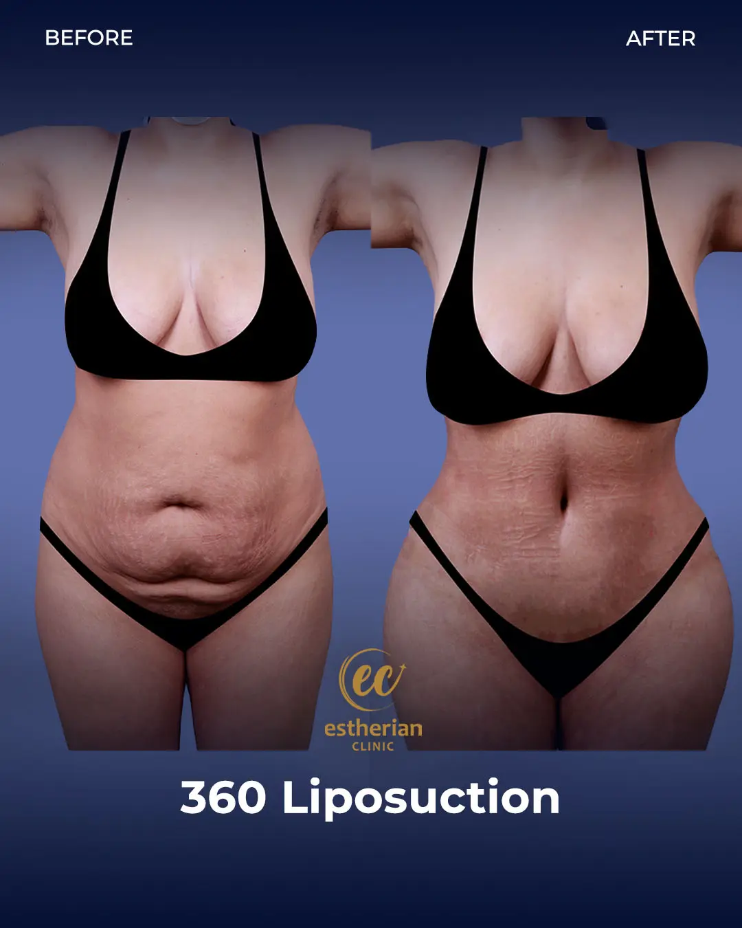 Liposuction (Real patient results) by the Estherian Clinic