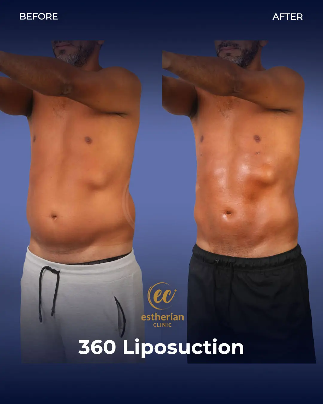 Liposuction (Real patient results) by the Estherian Clinic