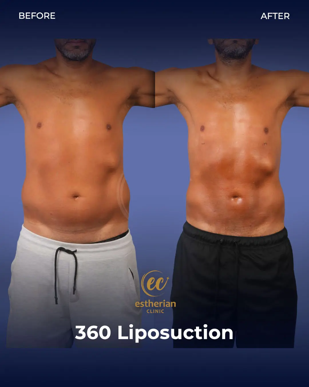 Liposuction (Real patient results) by the Estherian Clinic