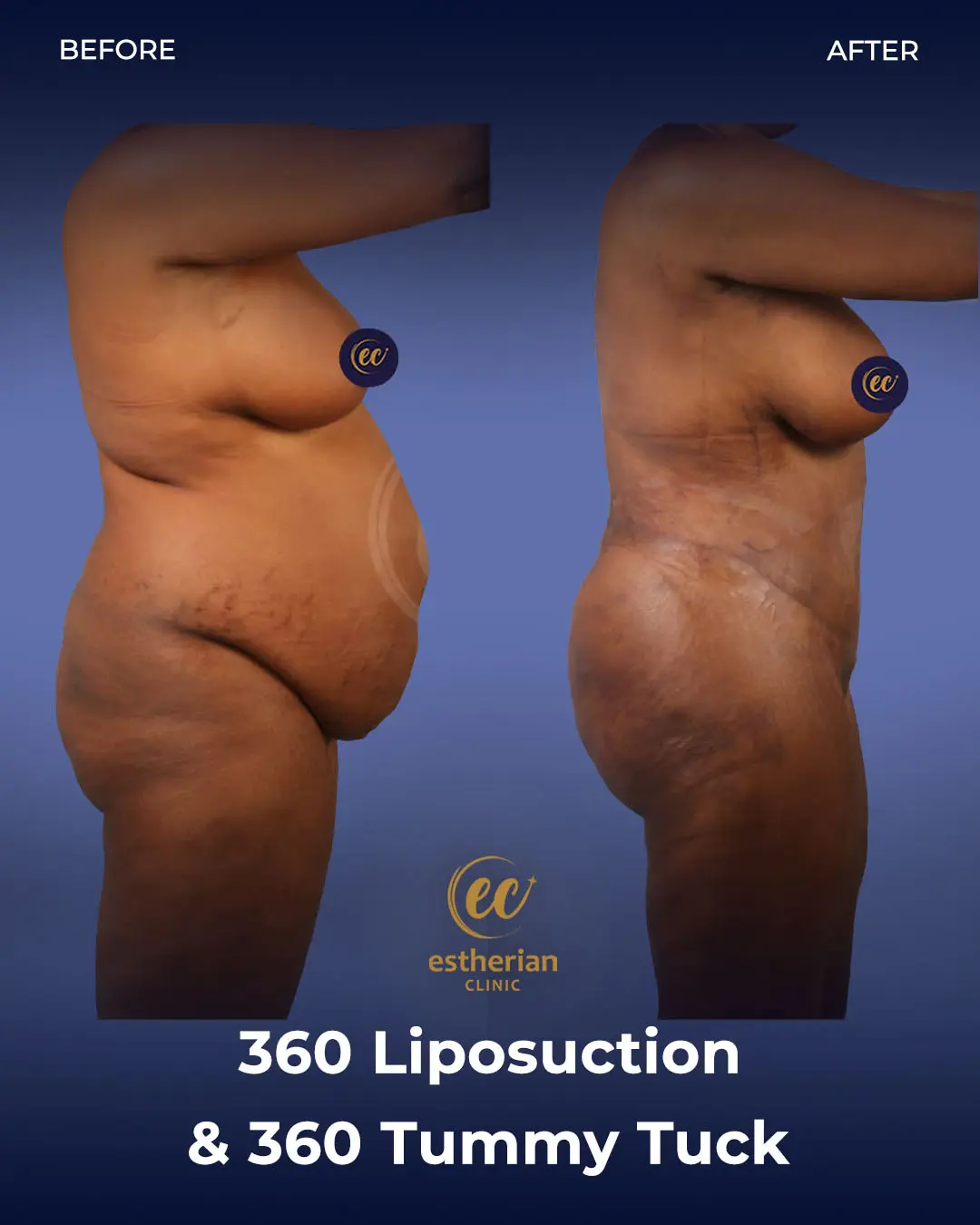Liposuction (Real patient results) by the Estherian Clinic
