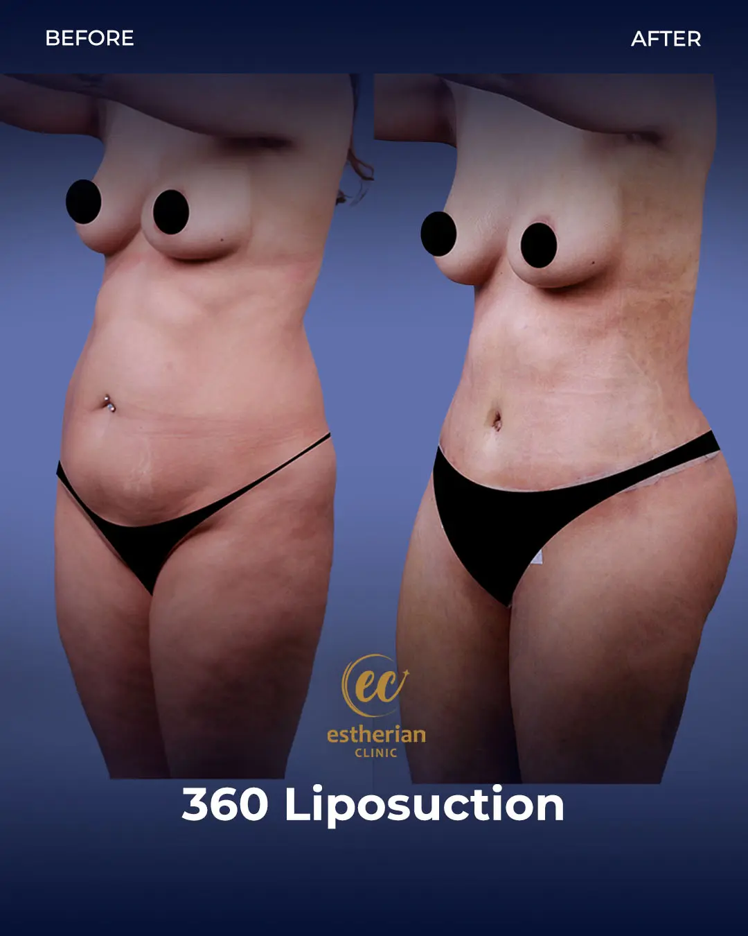Liposuction (Real patient results) by the Estherian Clinic