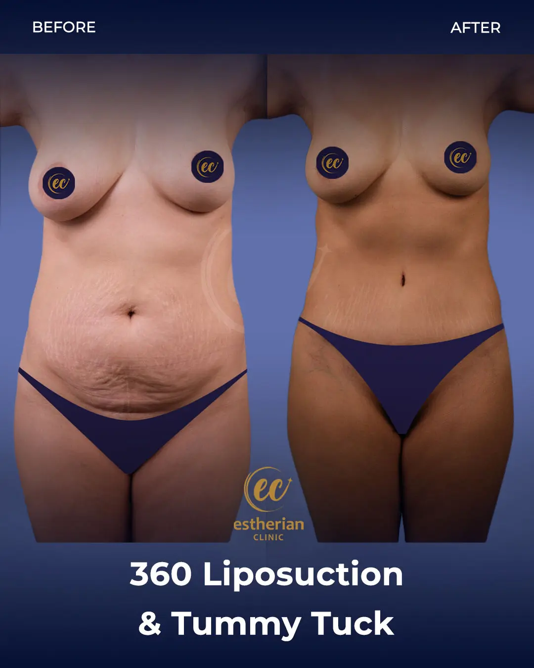 Liposuction (Real patient results) by the Estherian Clinic