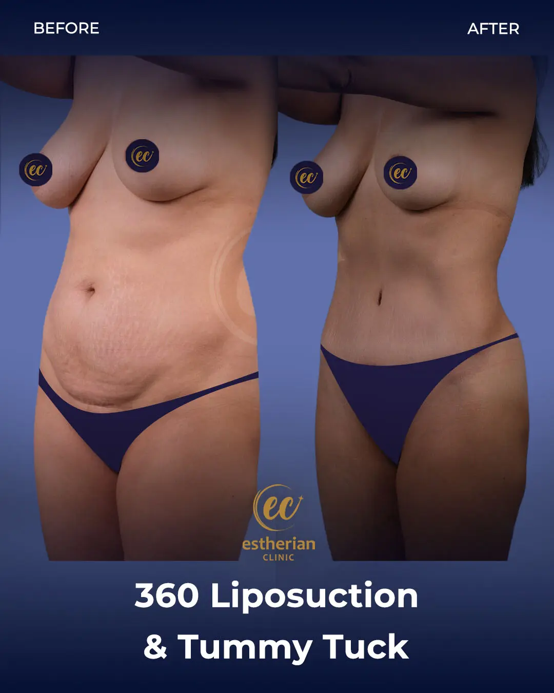 Liposuction (Real patient results) by the Estherian Clinic