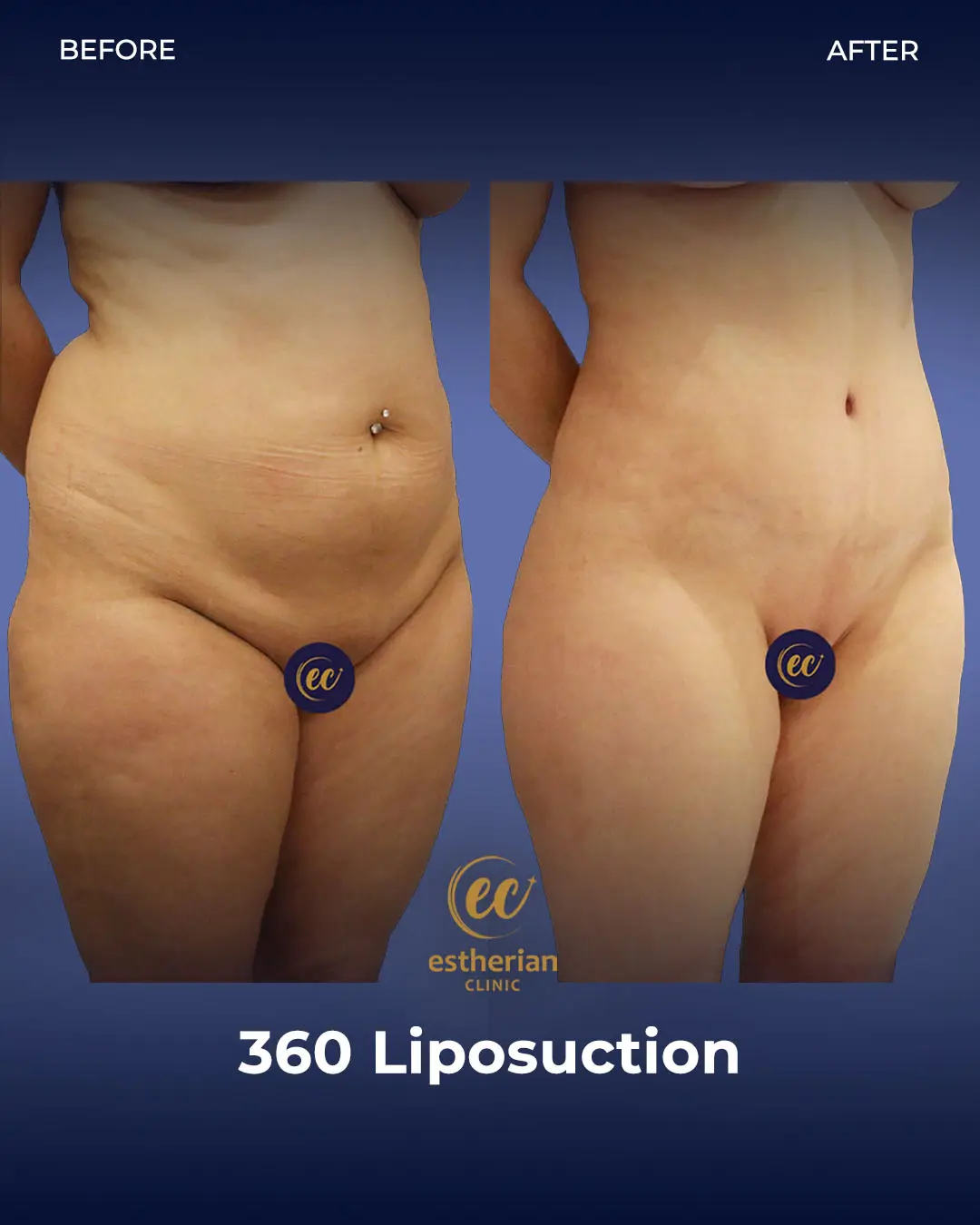 Liposuction (Real patient results) by the Estherian Clinic