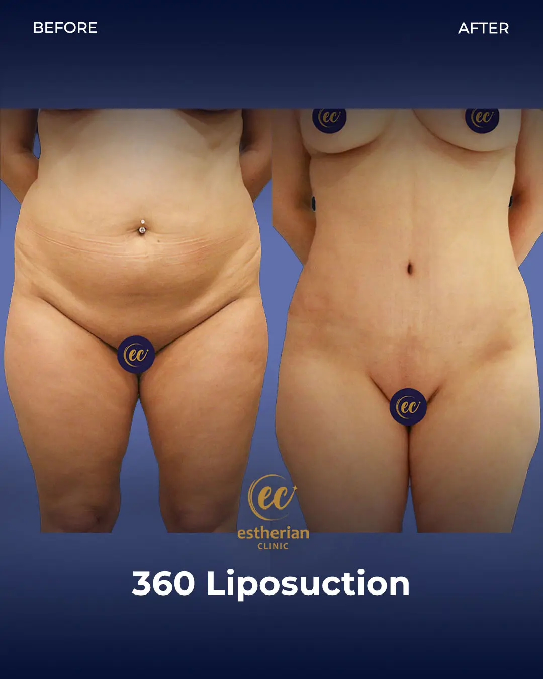 Liposuction (Real patient results) by the Estherian Clinic