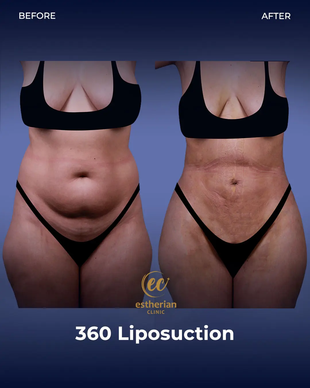 Liposuction (Real patient results) by the Estherian Clinic