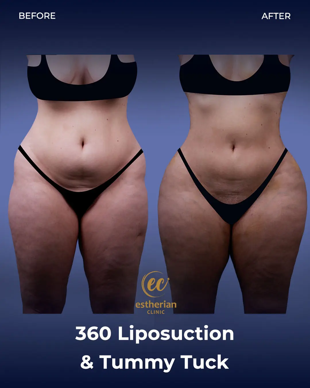 Liposuction (Real patient results) by the Estherian Clinic