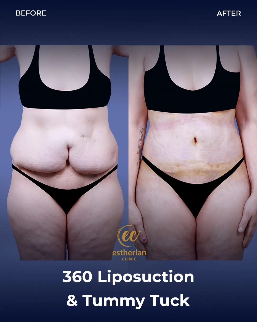 Liposuction (Real patient results) by the Estherian Clinic