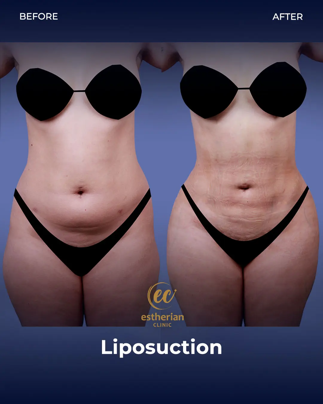 Liposuction (Real patient results) by the Estherian Clinic