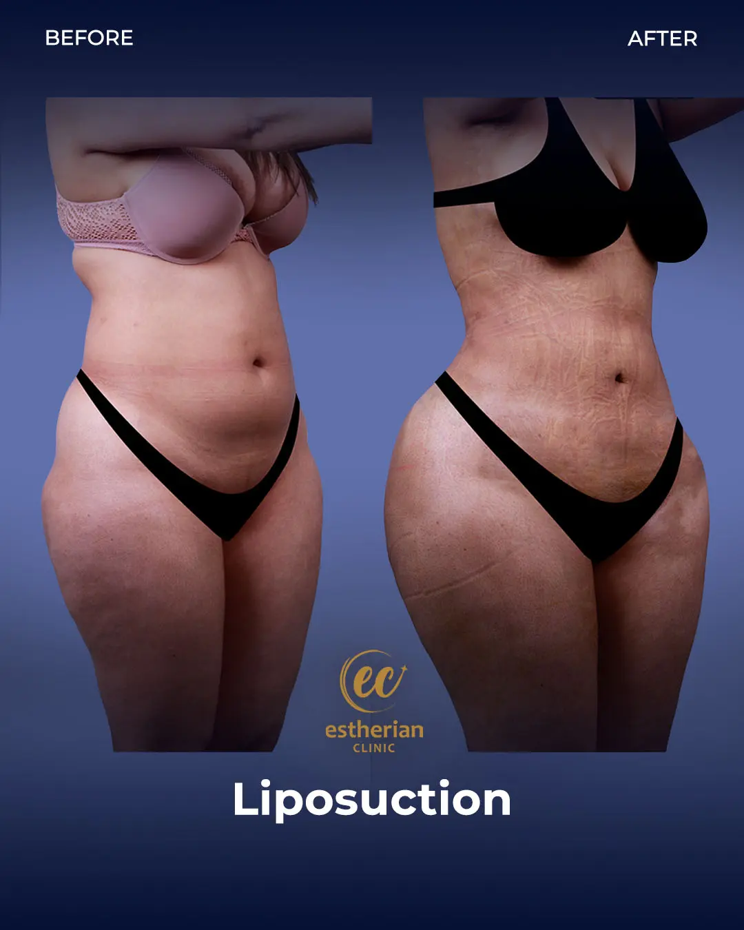 Liposuction (Real patient results) by the Estherian Clinic