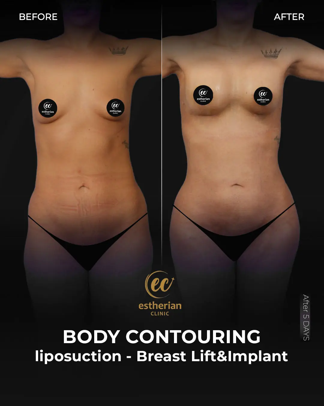 Liposuction (Real patient results) by the Estherian Clinic