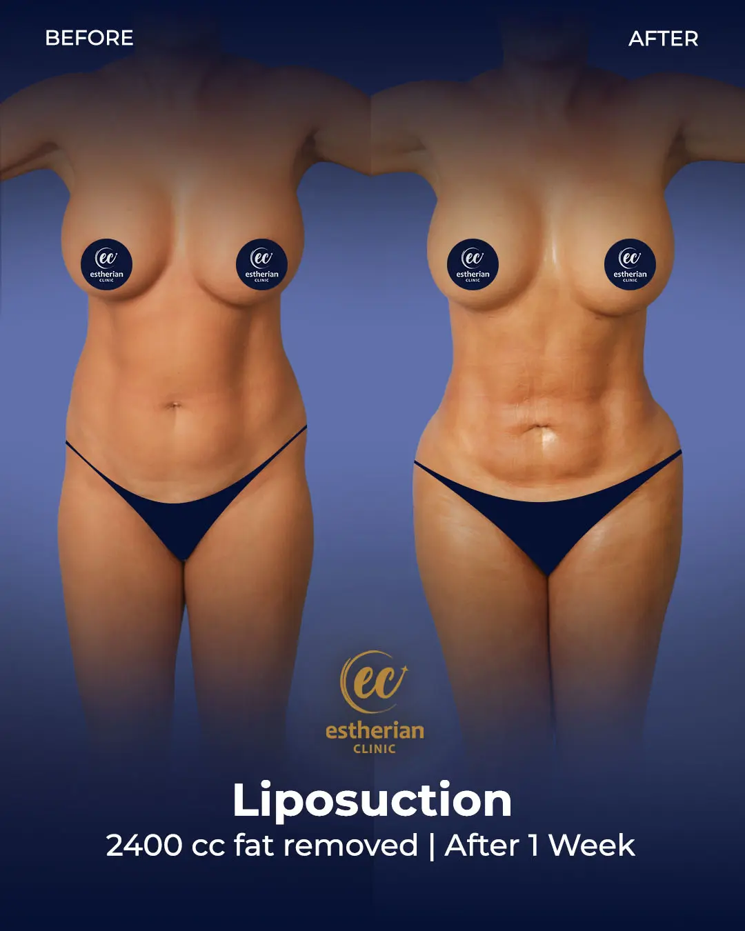 Liposuction (Real patient results) by the Estherian Clinic