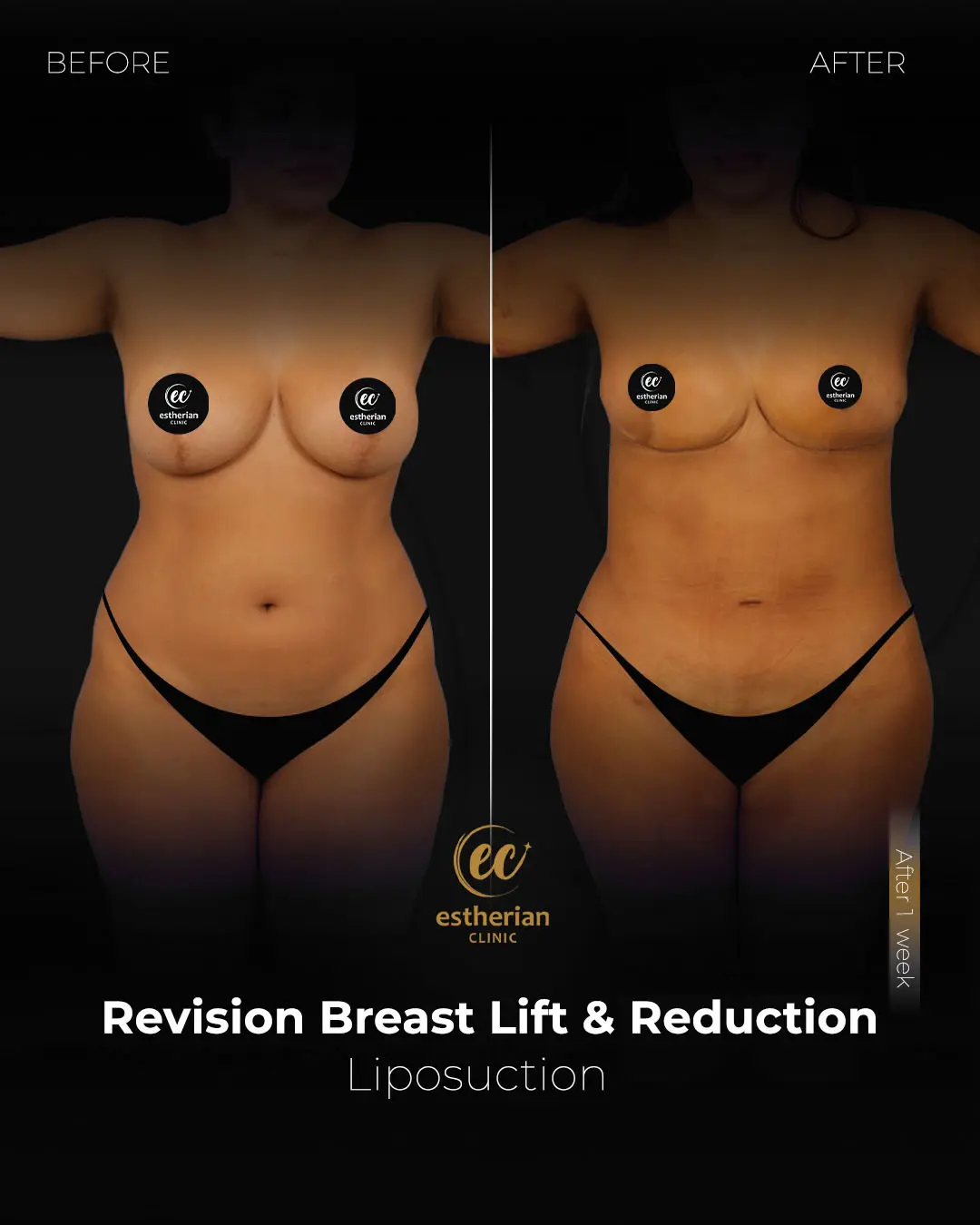 Liposuction (Real patient results) by the Estherian Clinic