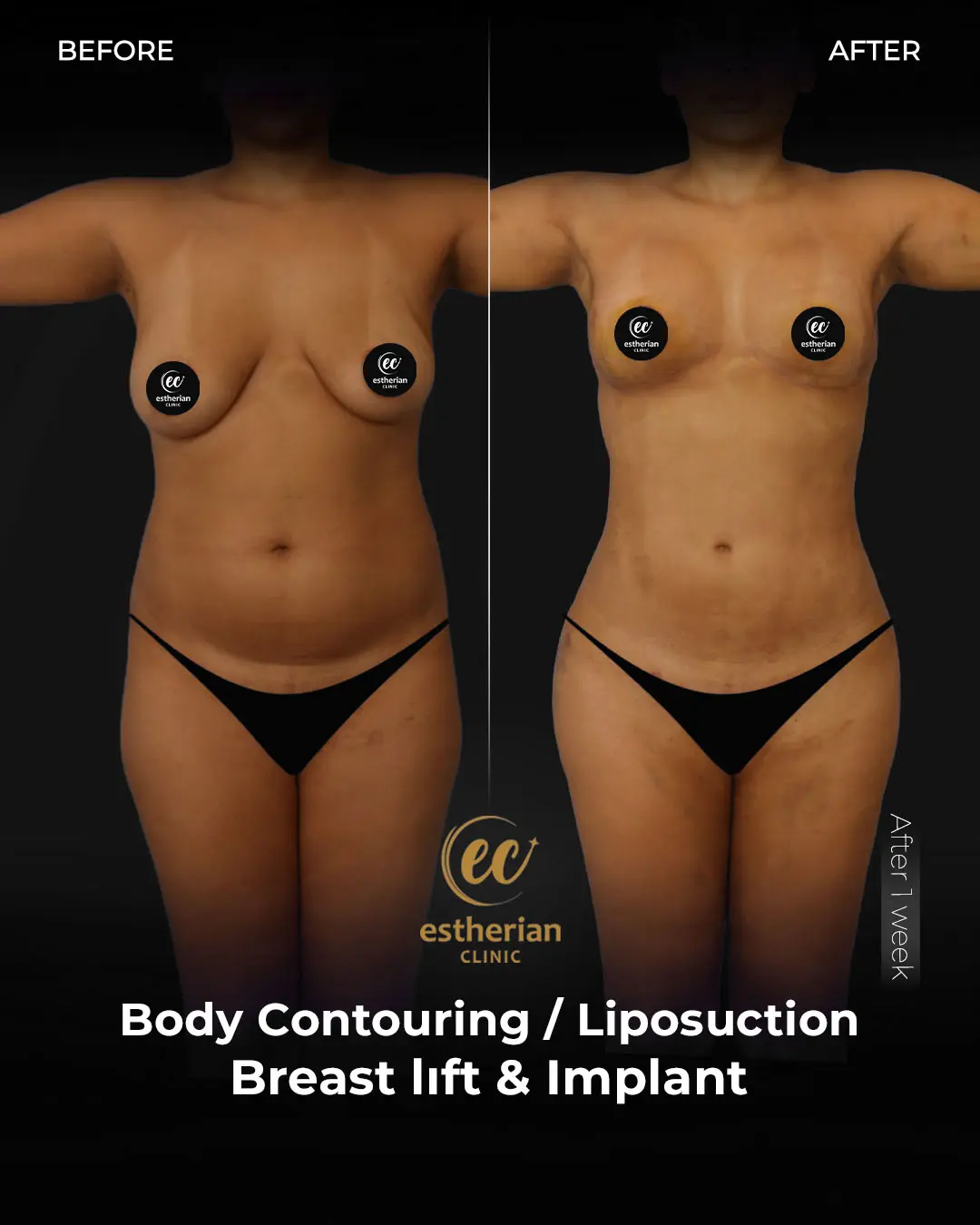 Liposuction (Real patient results) by the Estherian Clinic