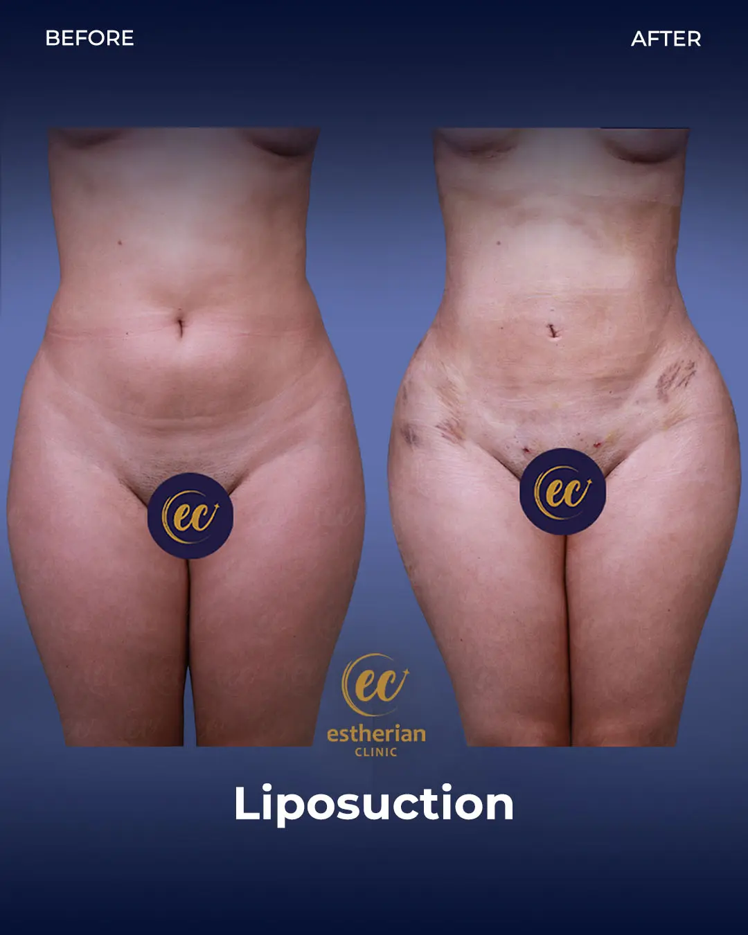 Liposuction (Real patient results) by the Estherian Clinic