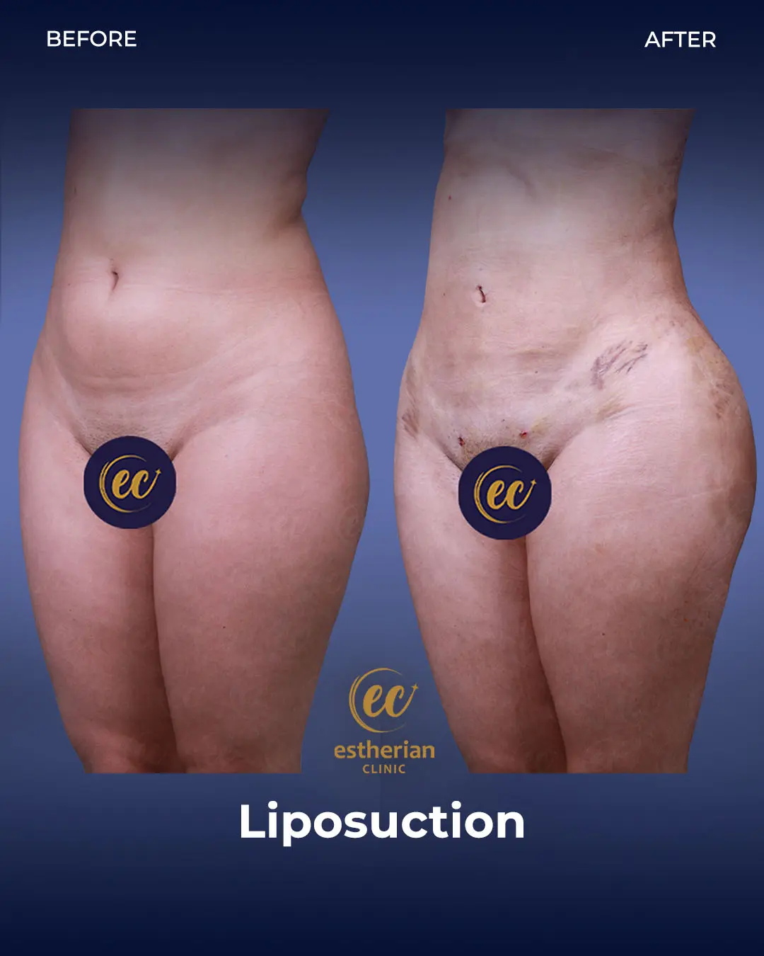 Liposuction (Real patient results) by the Estherian Clinic