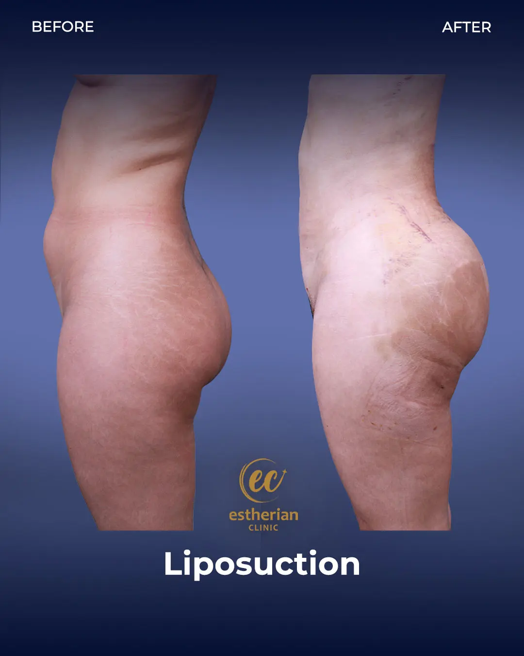 Liposuction (Real patient results) by the Estherian Clinic