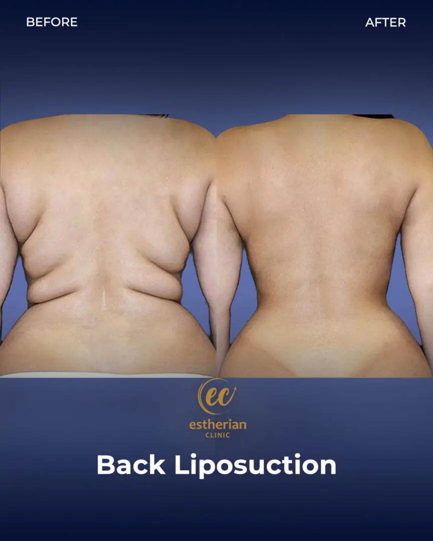 Liposuction (Real patient results) by the Estherian Clinic