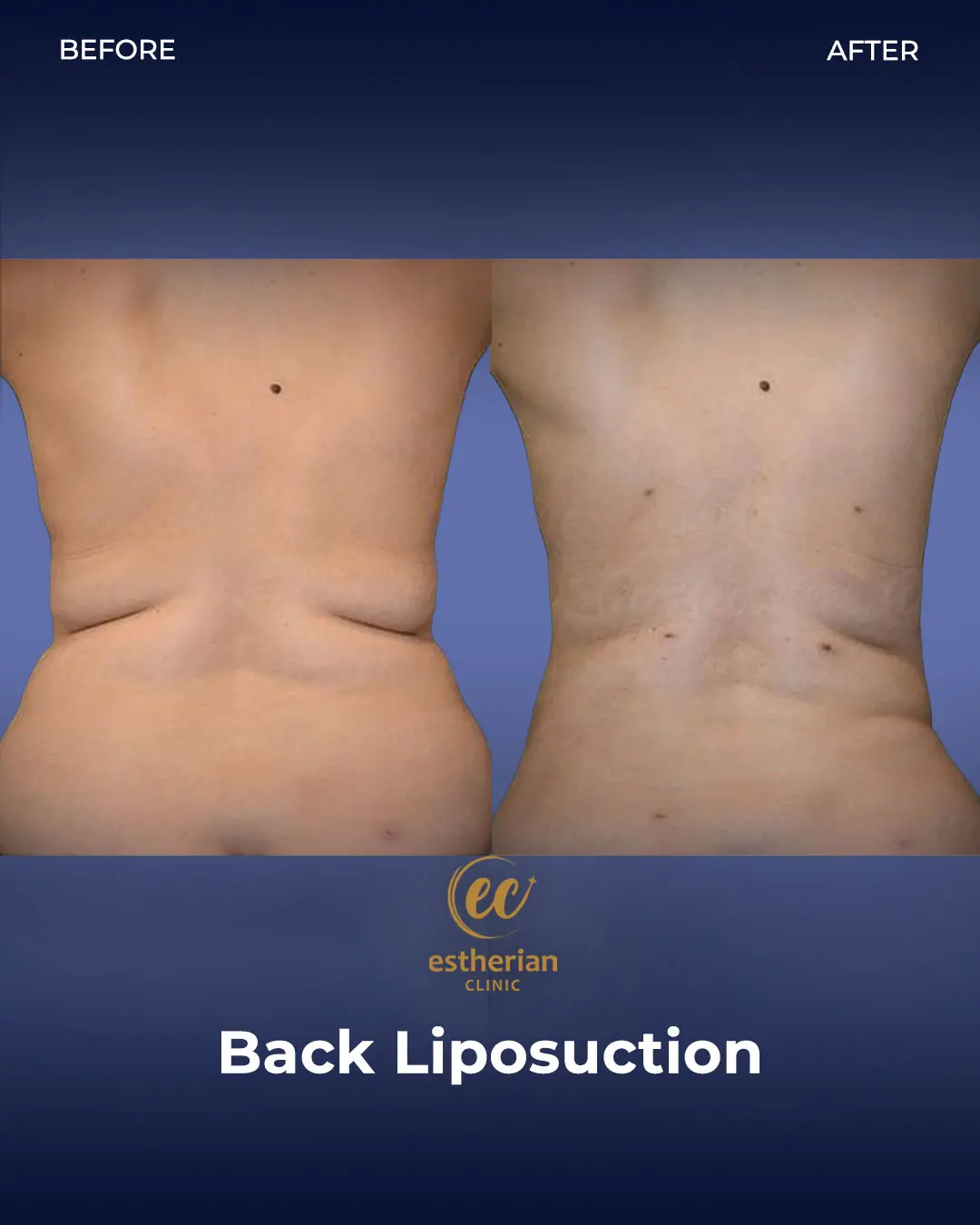 Liposuction (Real patient results) by the Estherian Clinic