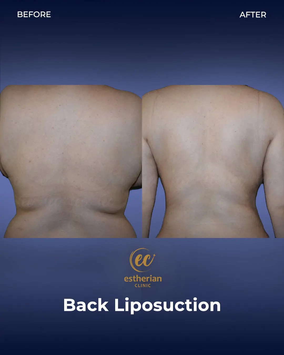 Liposuction (Real patient results) by the Estherian Clinic