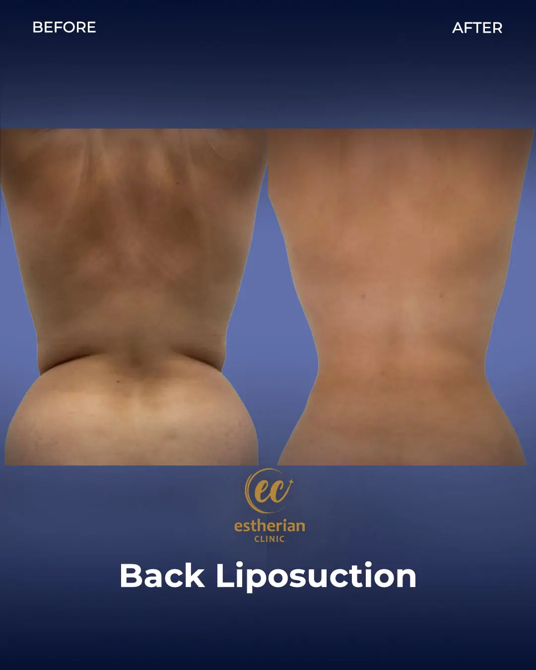 Liposuction (Real patient results) by the Estherian Clinic
