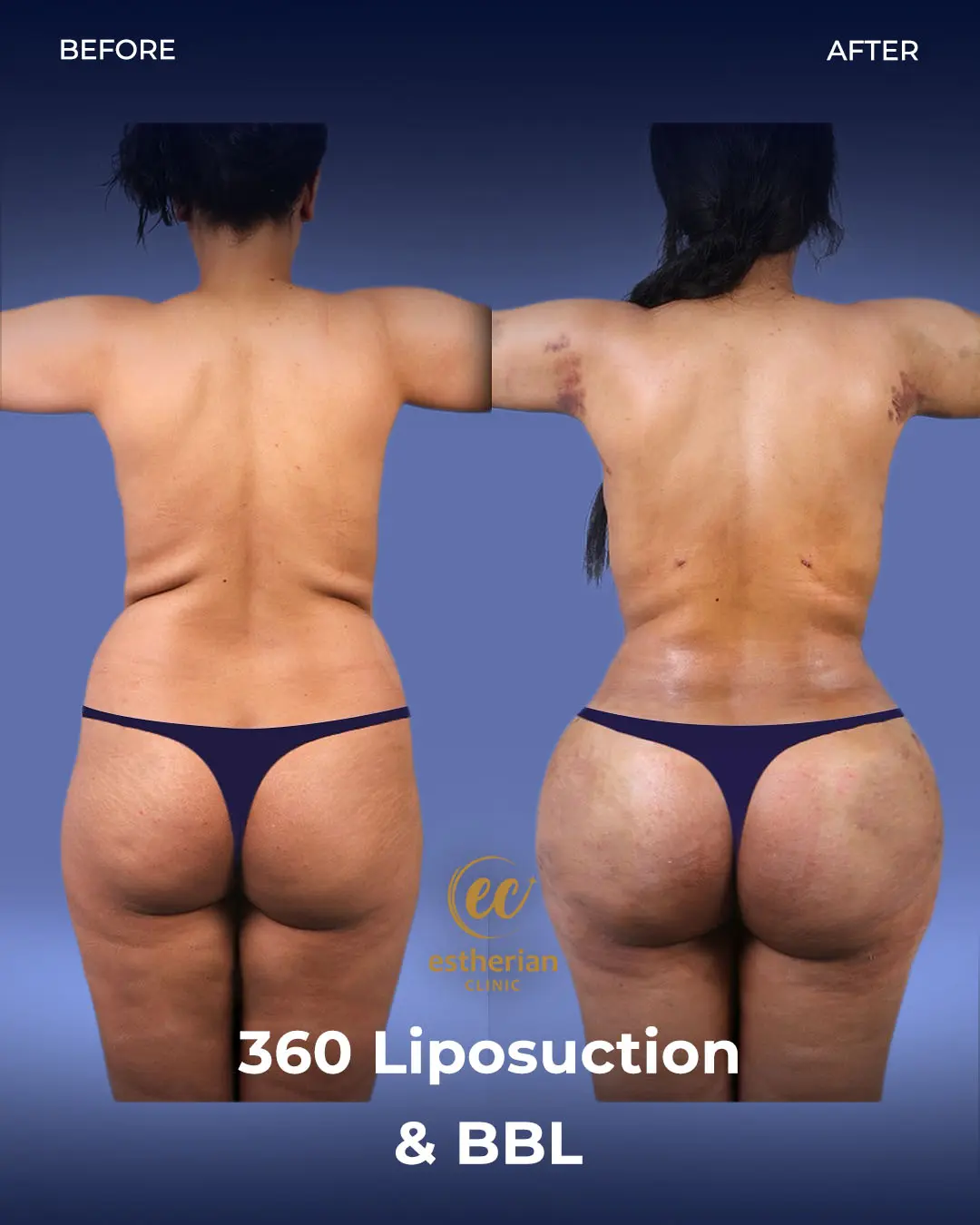 Liposuction (Real patient results) by the Estherian Clinic