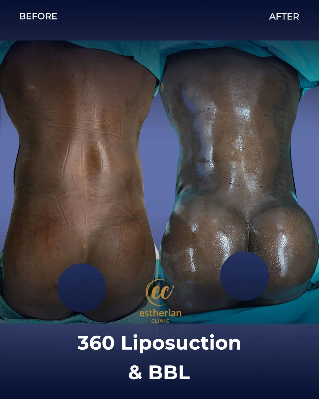 Liposuction (Real patient results) by the Estherian Clinic