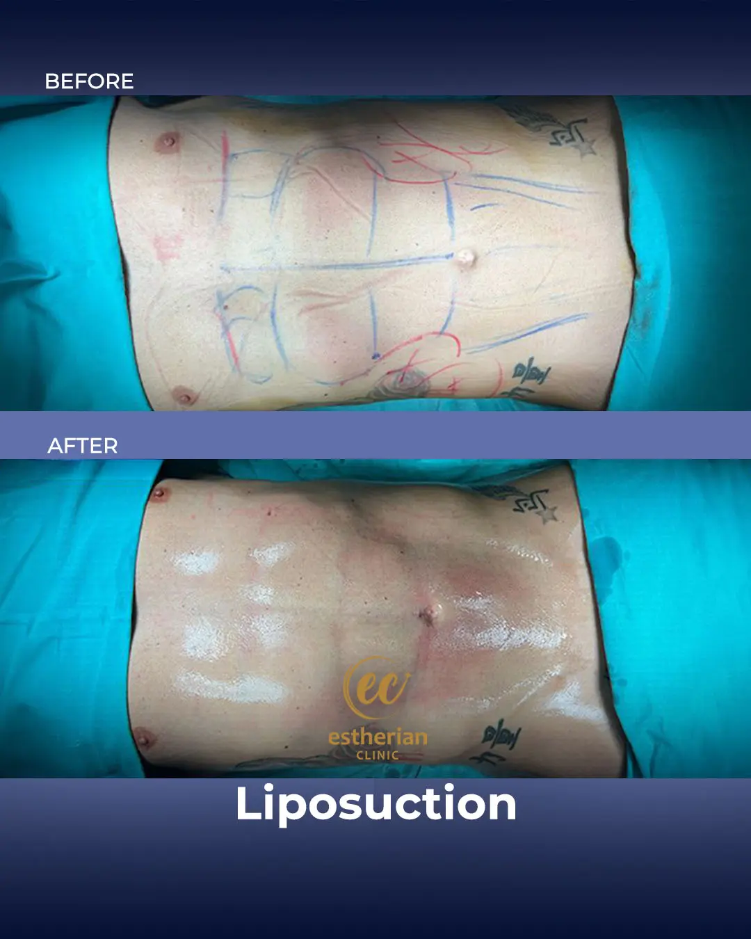 Liposuction (Real patient results) by the Estherian Clinic