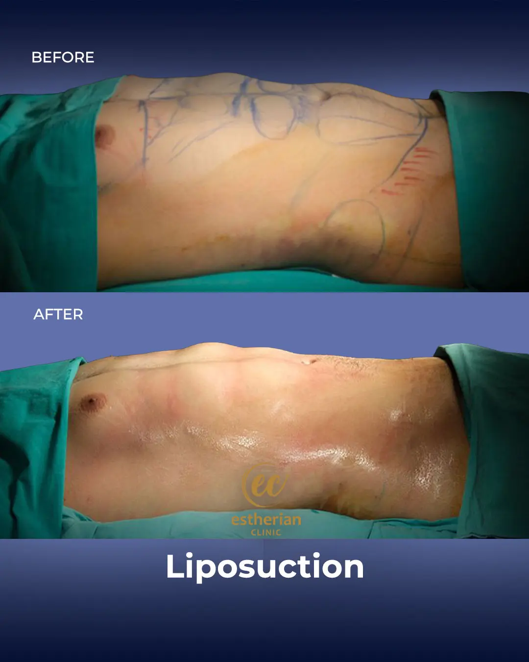 Liposuction (Real patient results) by the Estherian Clinic