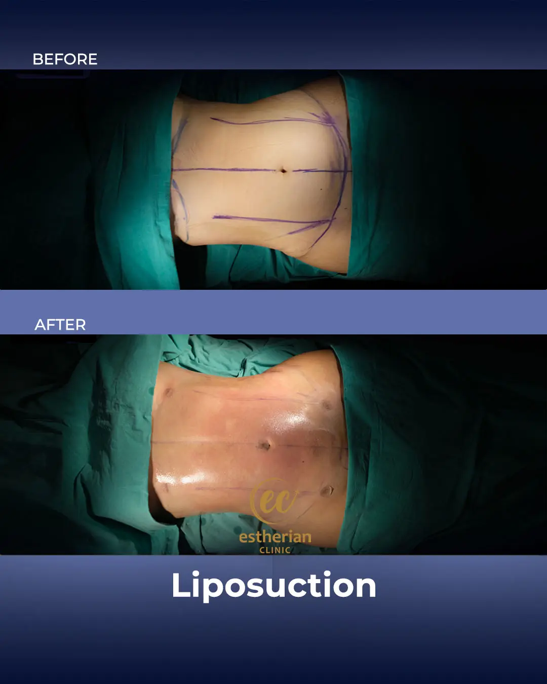 Liposuction (Real patient results) by the Estherian Clinic