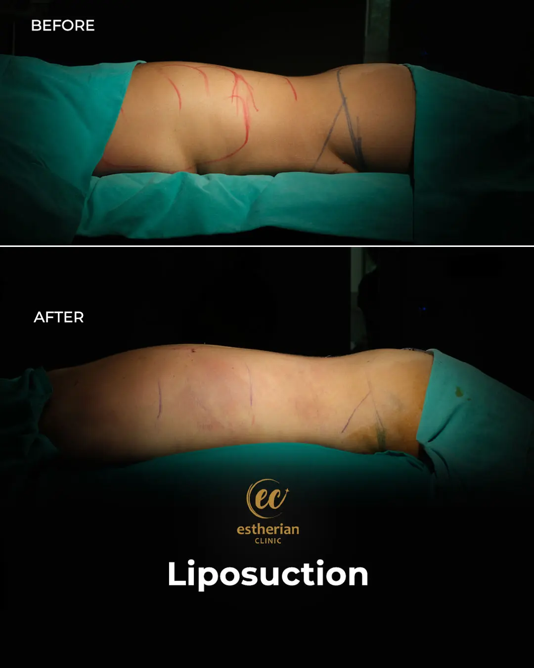 Liposuction (Real patient results) by the Estherian Clinic