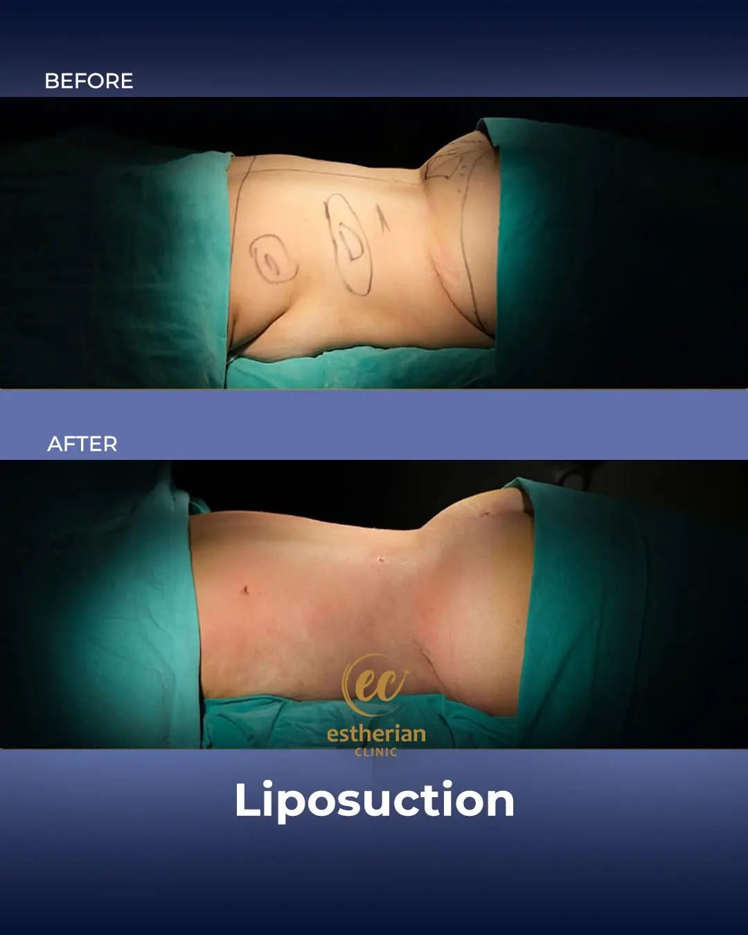 Liposuction (Real patient results) by the Estherian Clinic