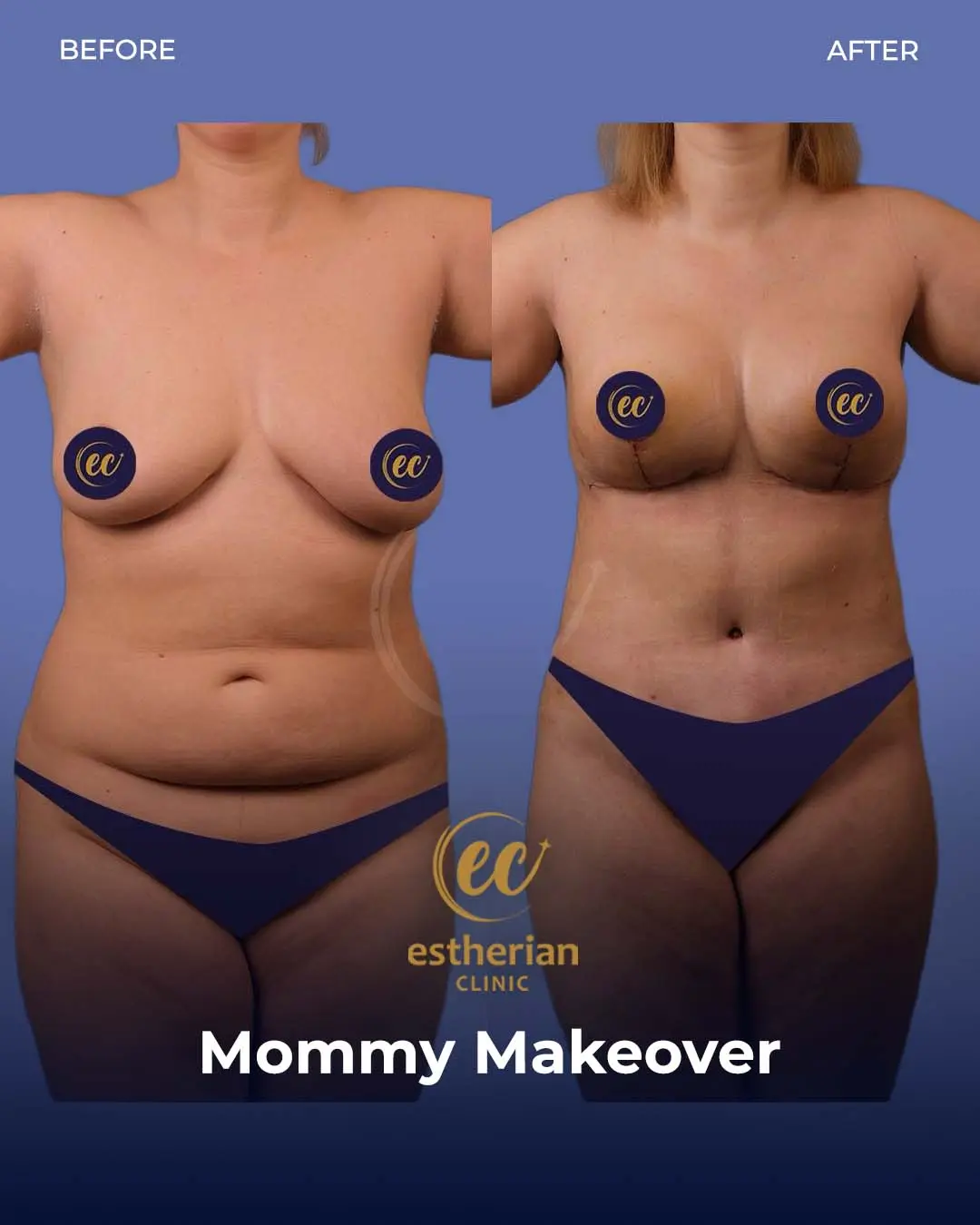 Body Contouring Surgery (before and after) by the Estherian Clinic