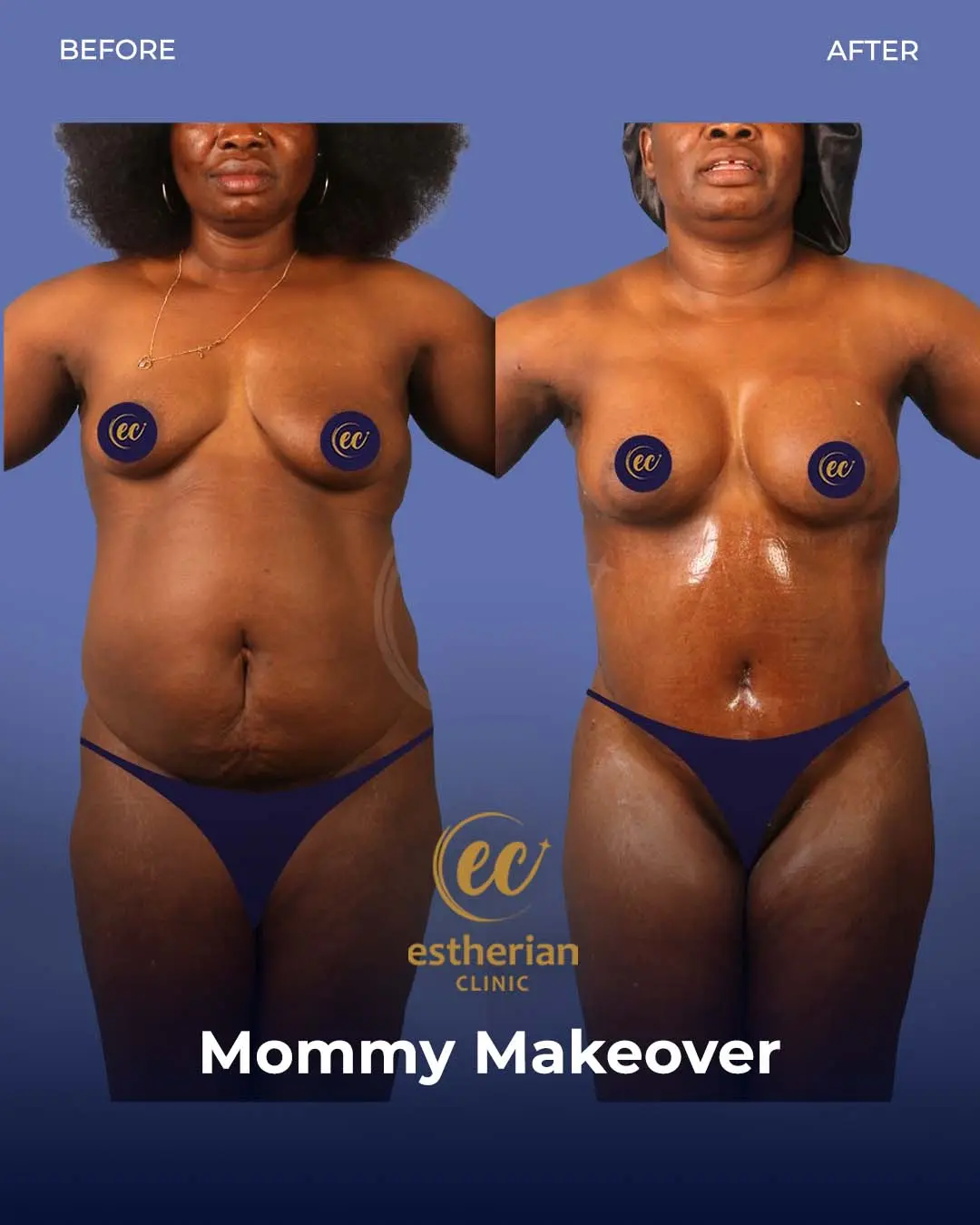 Body Contouring Surgery (before and after) by the Estherian Clinic