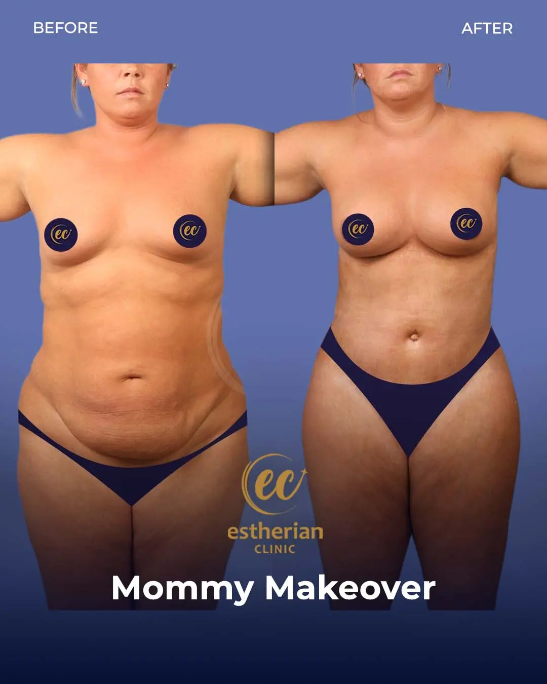 Body Contouring Surgery (before and after) by the Estherian Clinic