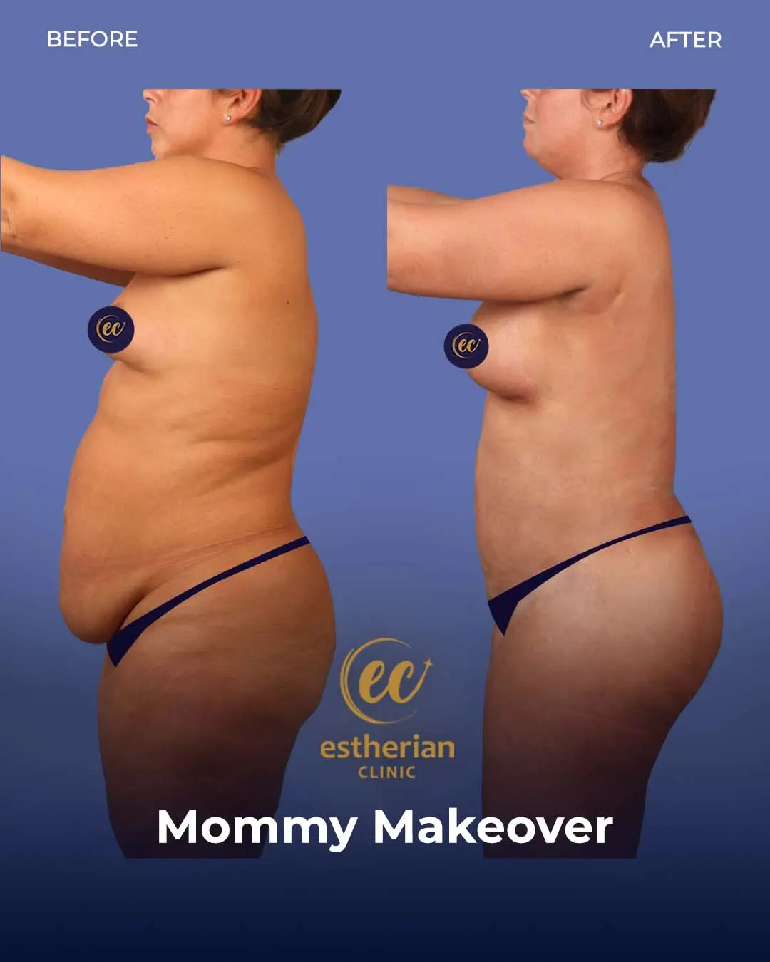 Body Contouring Surgery (before and after) by the Estherian Clinic