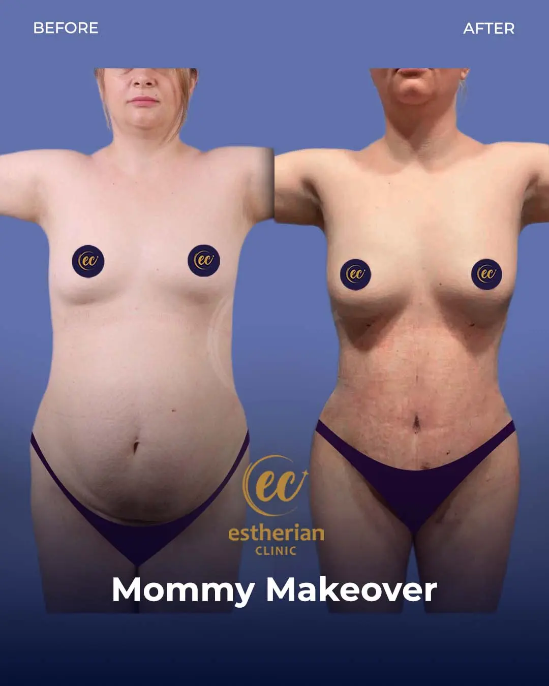Body Contouring Surgery (before and after) by the Estherian Clinic