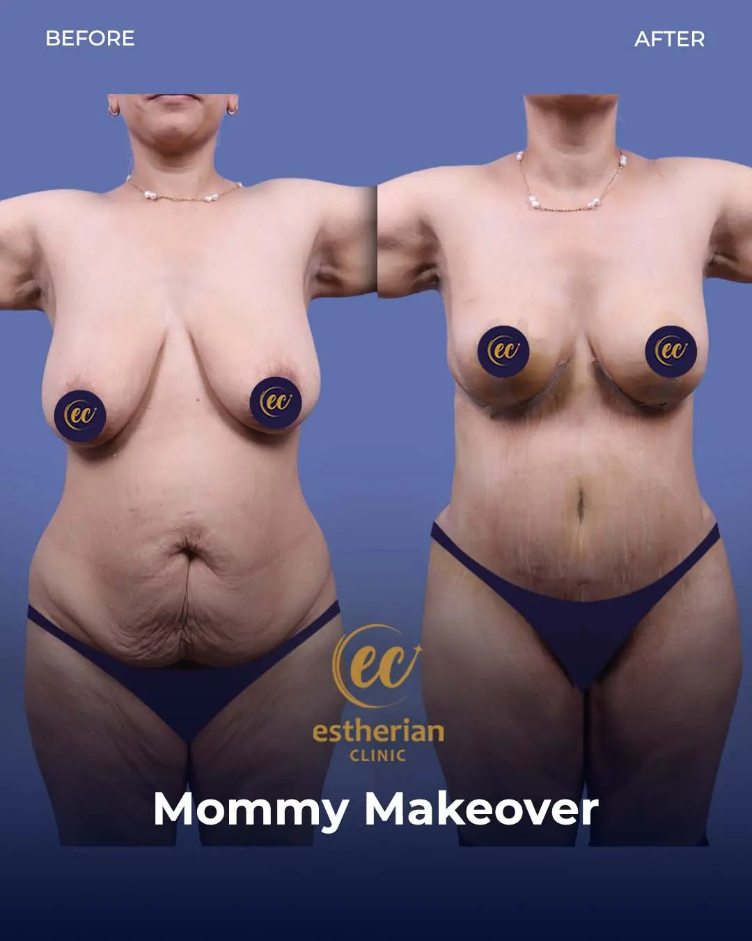 Tummy Tuck Before and after by the Estherian Clinic
