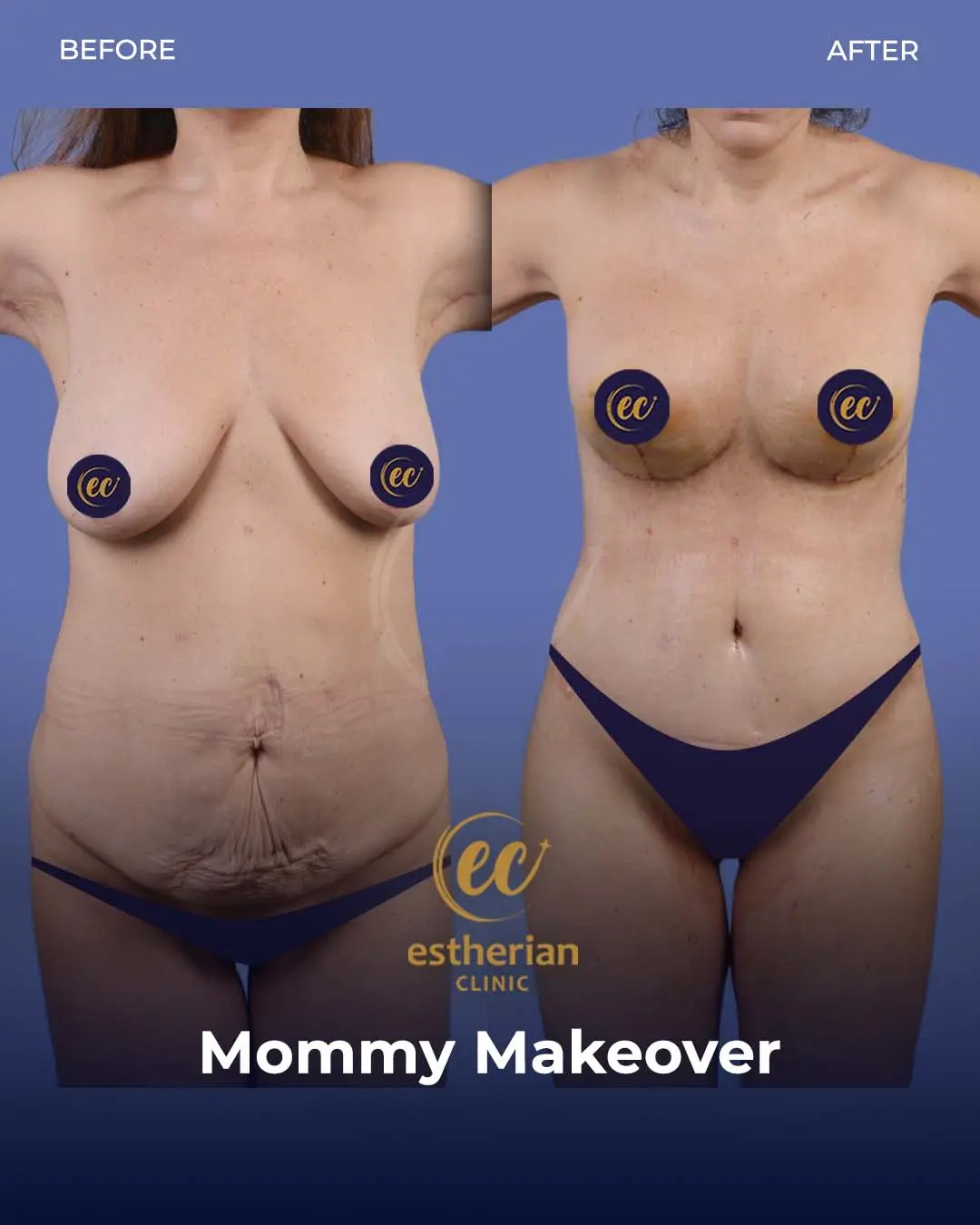 Body Contouring Surgery (before and after) by the Estherian Clinic