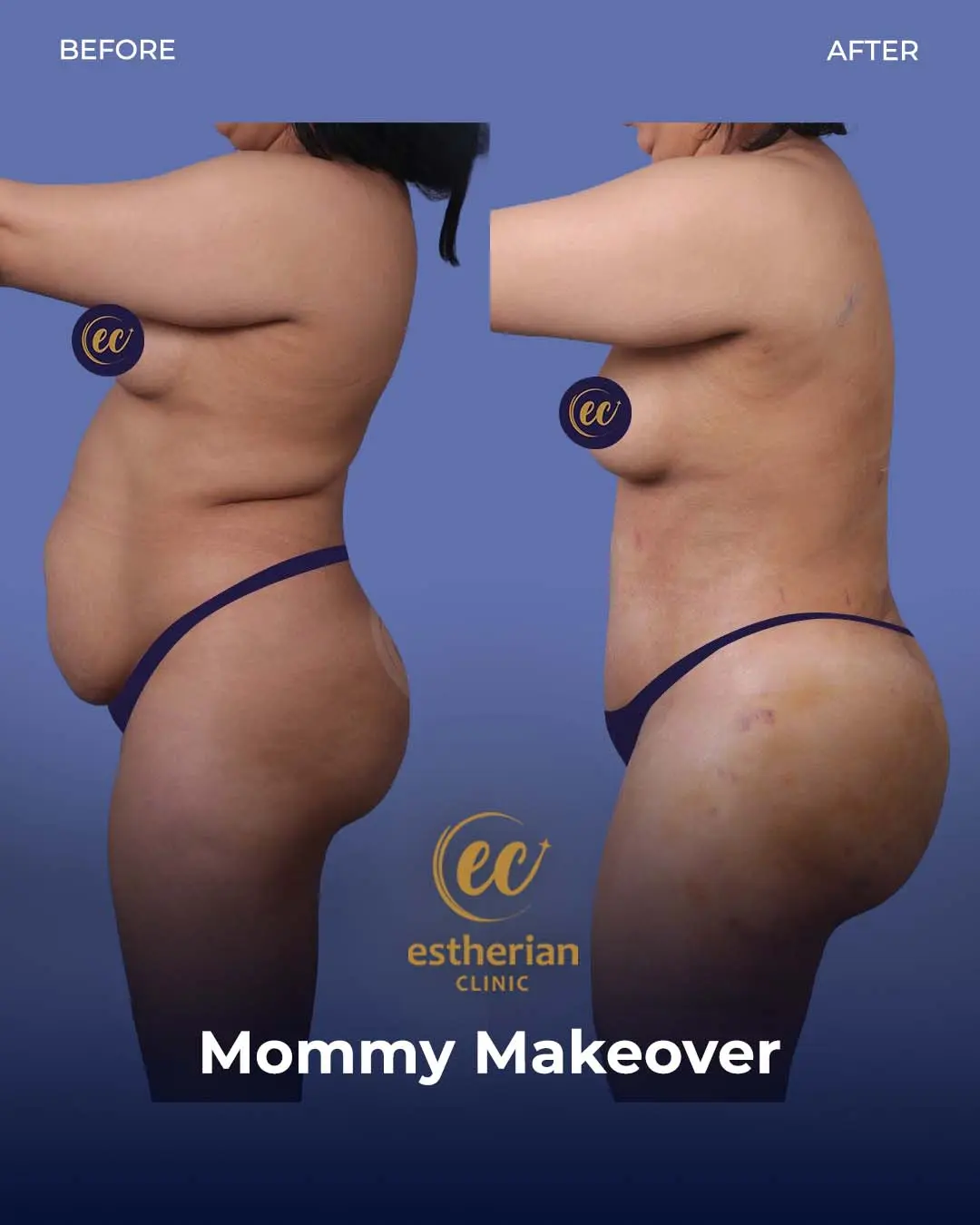Body Contouring Surgery (before and after) by the Estherian Clinic