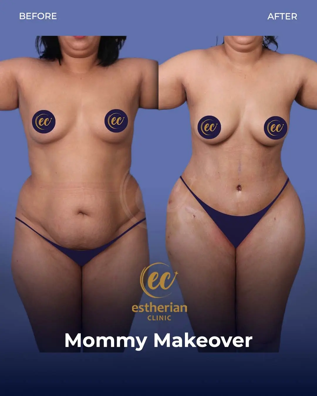 Body Contouring Surgery (before and after) by the Estherian Clinic