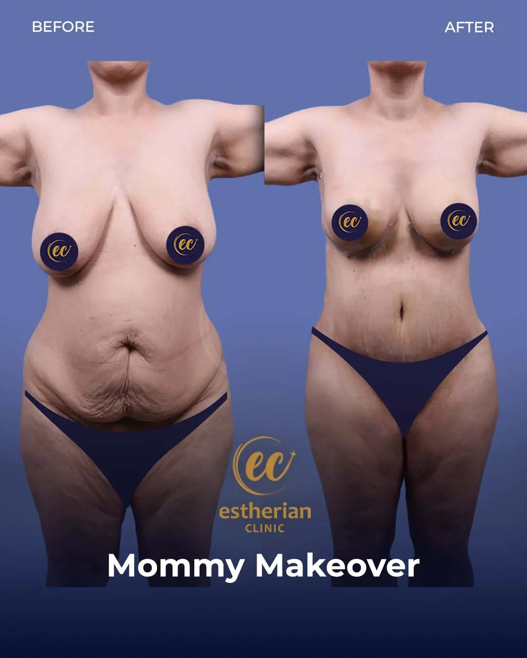 Mommy Makeover Before and After by the Estherian