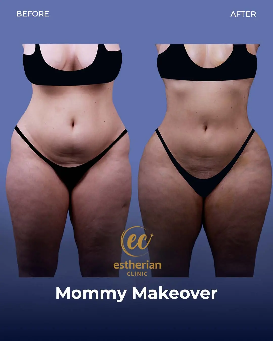 Body Contouring Surgery (before and after) by the Estherian Clinic