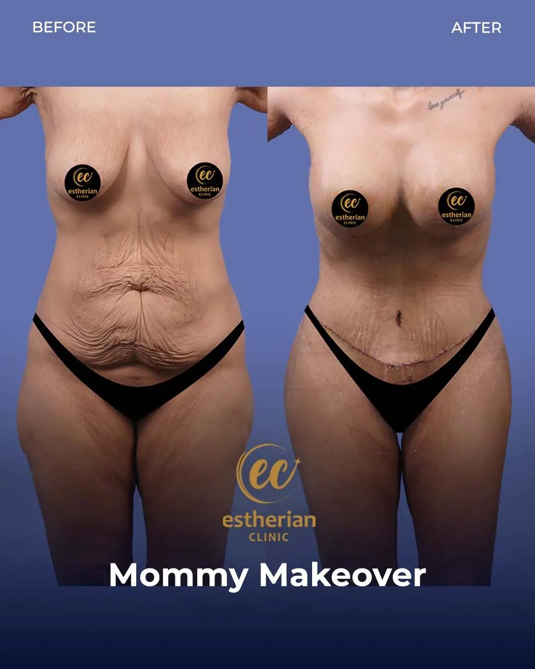 Body Contouring Surgery (before and after) by the Estherian Clinic
