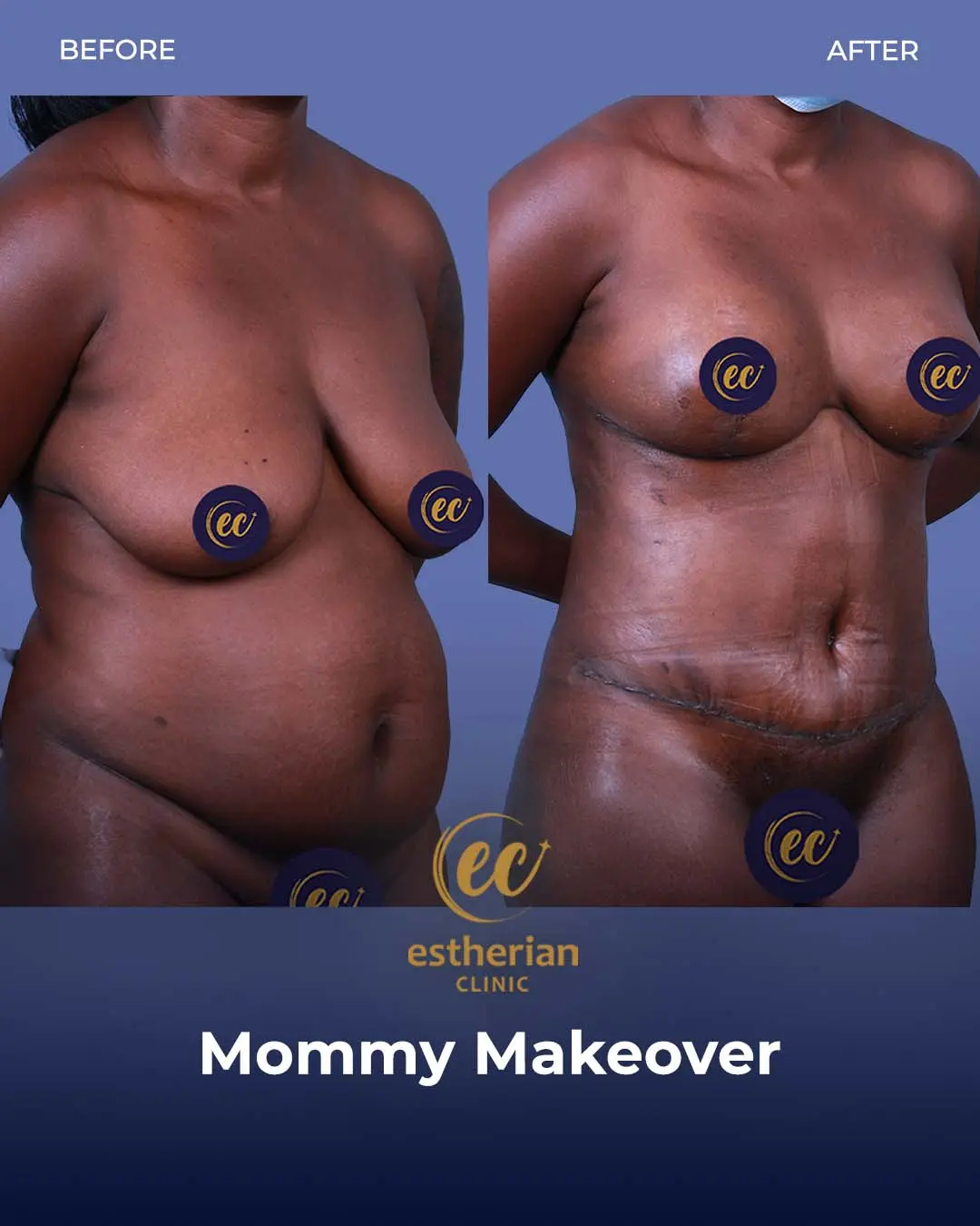 Body Contouring Surgery (before and after) by the Estherian Clinic
