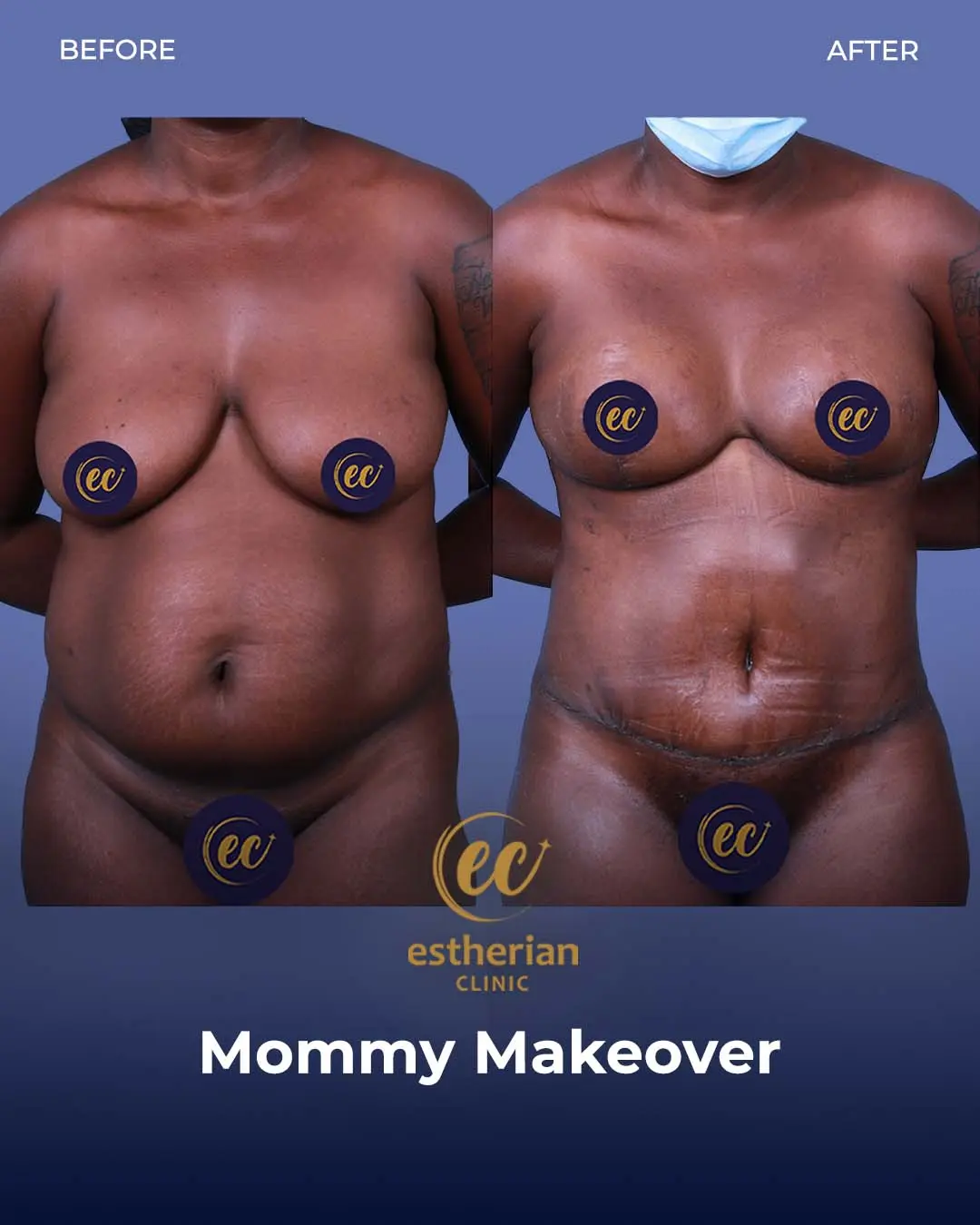 Body Contouring Surgery (before and after) by the Estherian Clinic