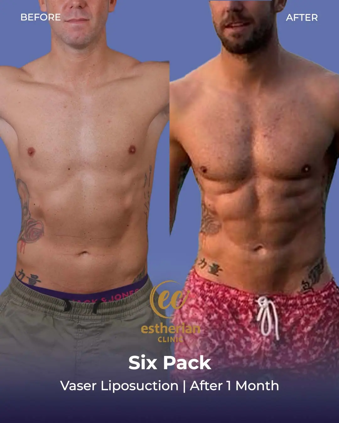 Six-pack liposuction before-and-after photo by the Estherian Clinic