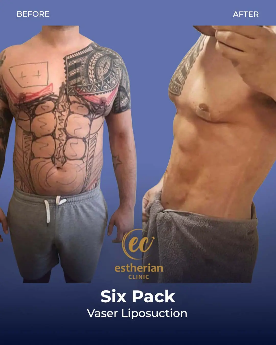 Six-pack liposuction before-and-after photo by the Estherian Clinic