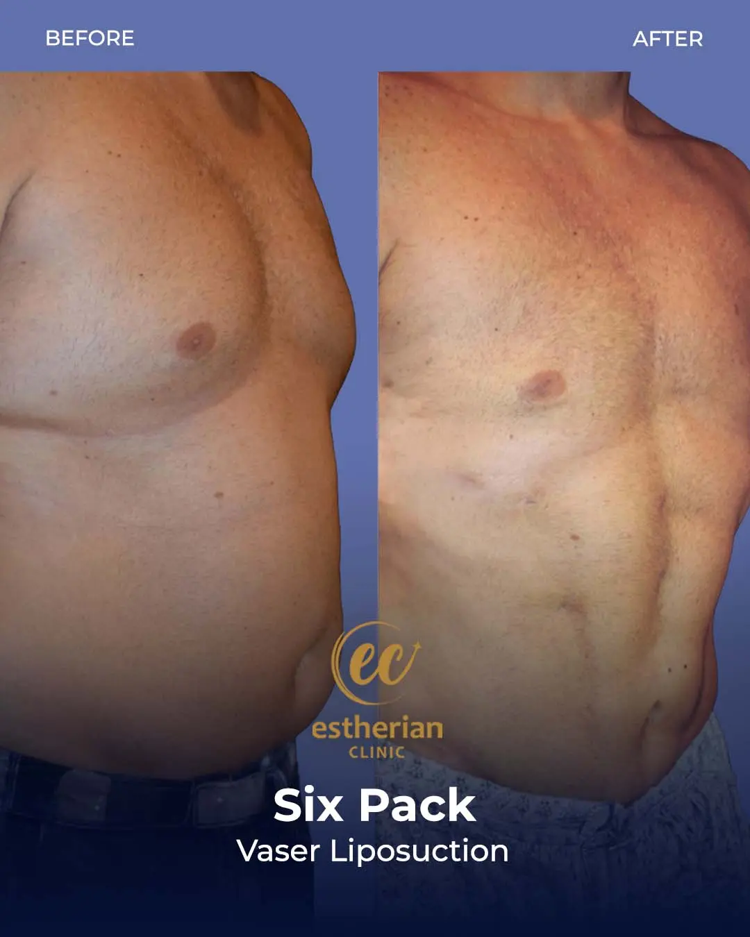 Six-pack liposuction before-and-after photo by the Estherian Clinic