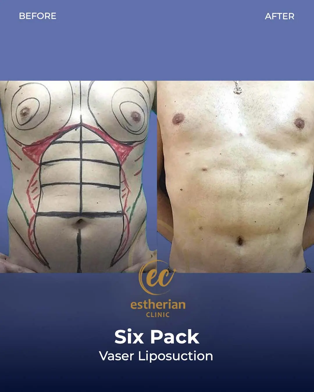 Six-pack liposuction before-and-after photo by the Estherian Clinic